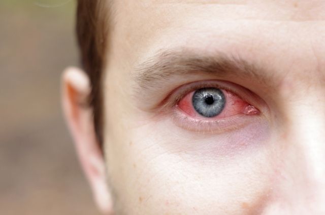 Проблемы со зрением могут указывать на перенесенный коронавирус